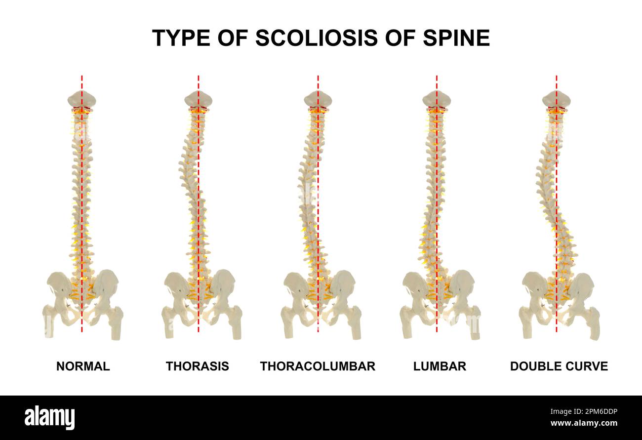 Poster medico che mostra i tipi di scoliosi su sfondo bianco. Illustrazione di spina dorsale sana e malata Foto Stock