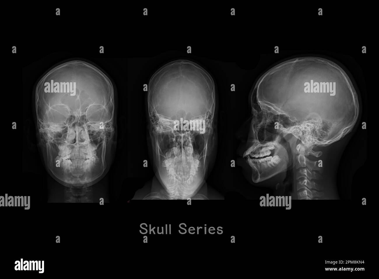 Immagine radiografica del cranio AP, Town e vista laterale o serie cranio per diagnosi frattura cranica isolata su sfondo nero. Foto Stock