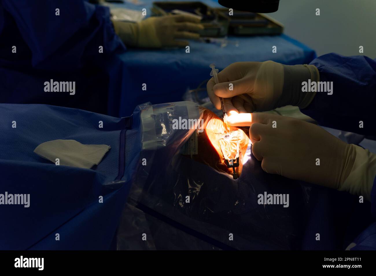 Primo piano delle mani di un chirurgo che esegue una puntura nella camera anteriore dell'occhio di un paziente durante un intervento di cataratta per introdurre antibiotici. Blu Foto Stock