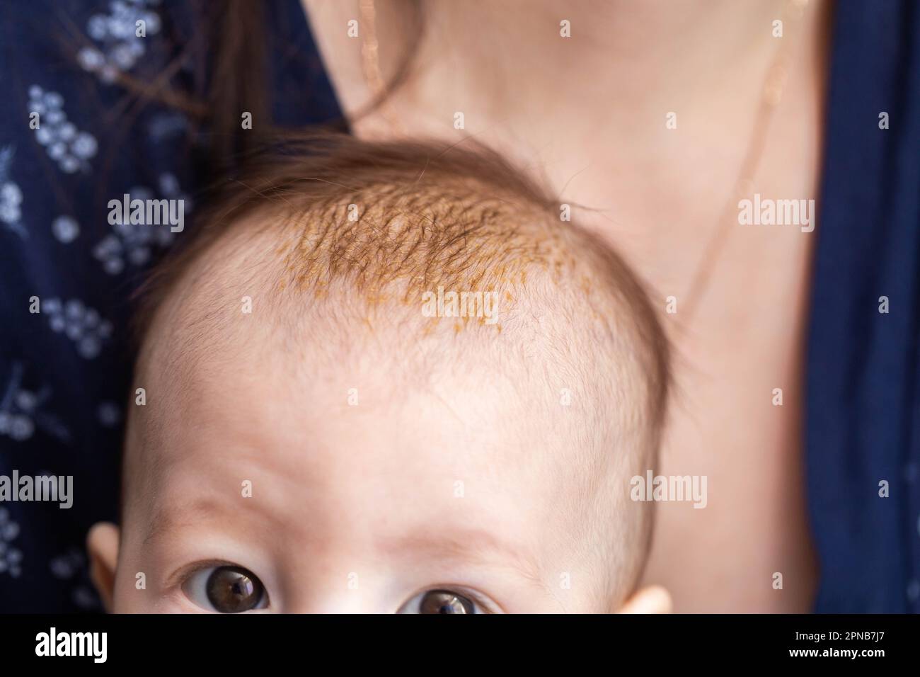 Dermatite seborroica sulla pelle sulla testa di un bambino di 6 mesi. Scale gialle sulla testa. Foto Stock