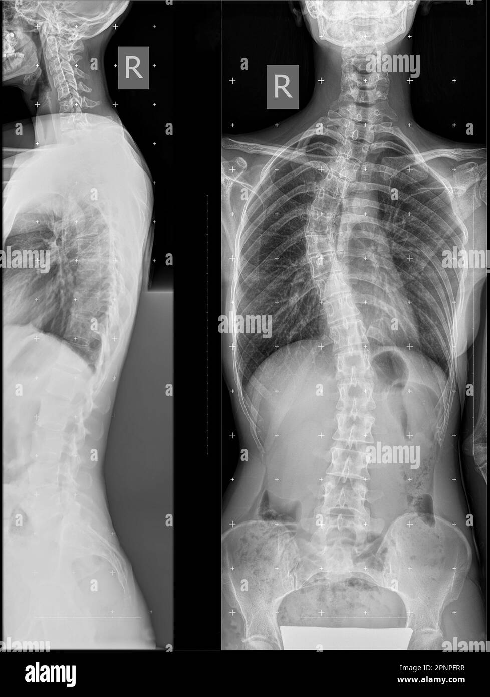 Radiografia panoramica della colonna vertebrale in due proiezioni. Deformità laterale destra ad arco singolo della colonna toracica. squilibrio coronarico. Raggi X della colonna vertebrale con c Foto Stock