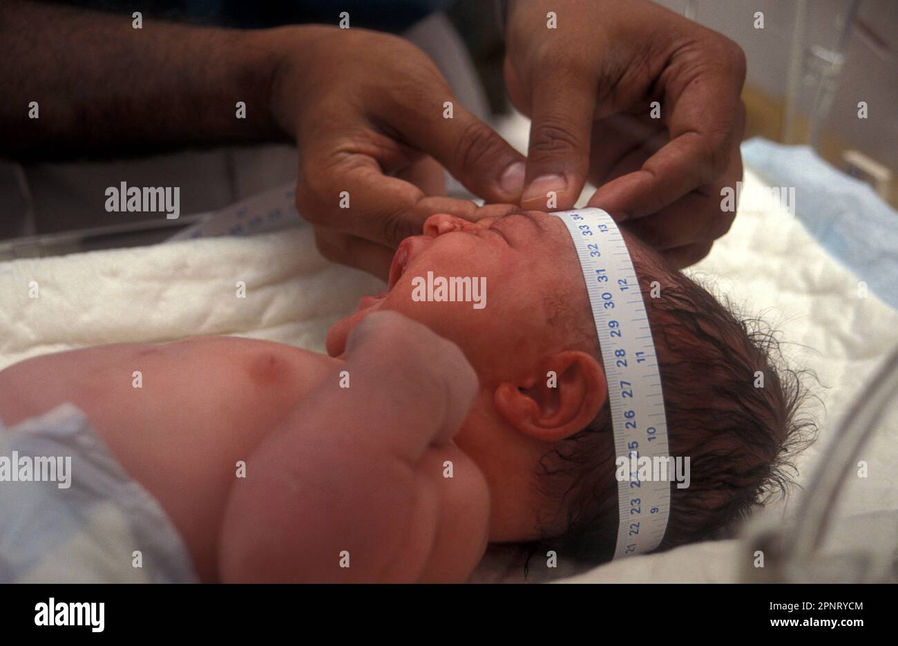 I neonati con testa allungata a causa di un lungo lavoro Foto stock - Alamy