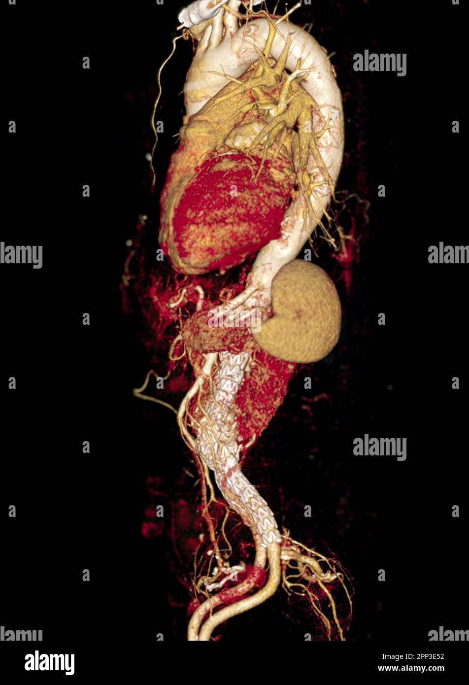 CTA dell'aorta con innesto con stent in aneurisma aortico addominale del paziente. Foto Stock