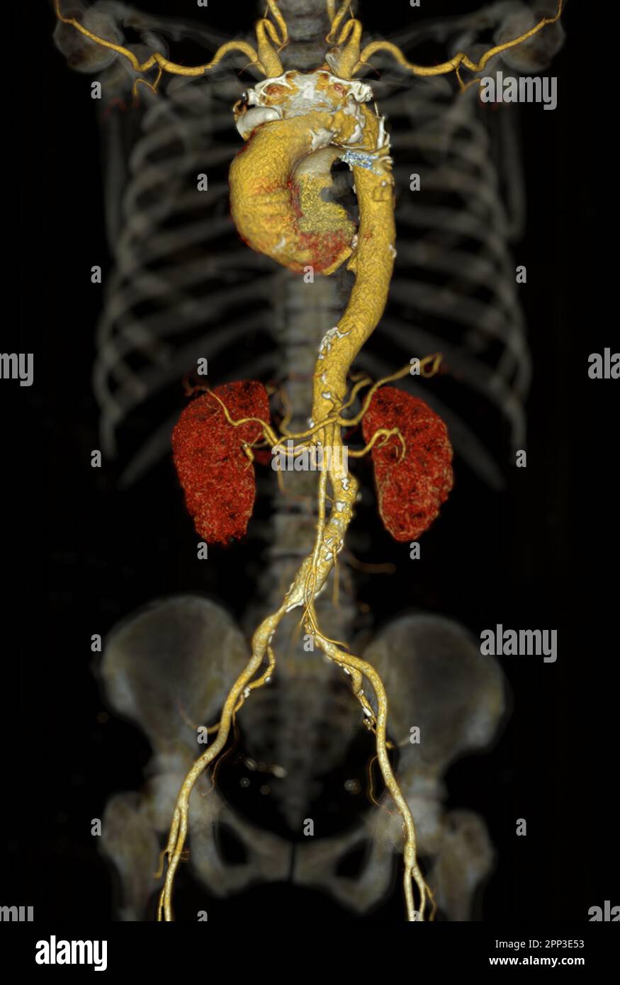 Resa CTA aorta intera 3D. Foto Stock