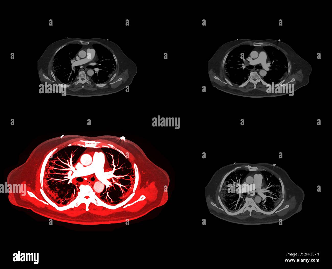 Rappresentazione delle arterie polmonari CTA 3D che mostra il ramo dell'arteria polmonare Foto Stock