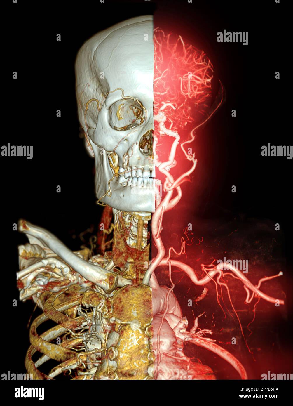 CTA cervello e arteria carotide o angiografia TC del cervello 3D immagine di rendering . Foto Stock