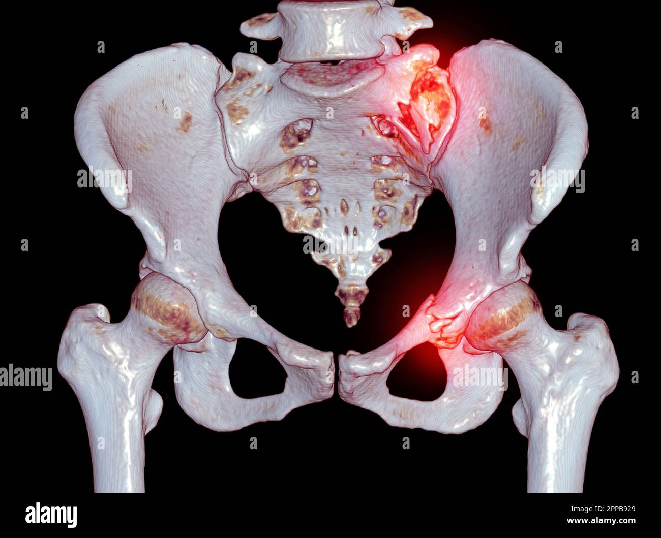 CT scansione osso pelvico con entrambe le articolazioni dell'anca 3D che rendono frattura showgn del sacro e rumus pubico superiore. Foto Stock