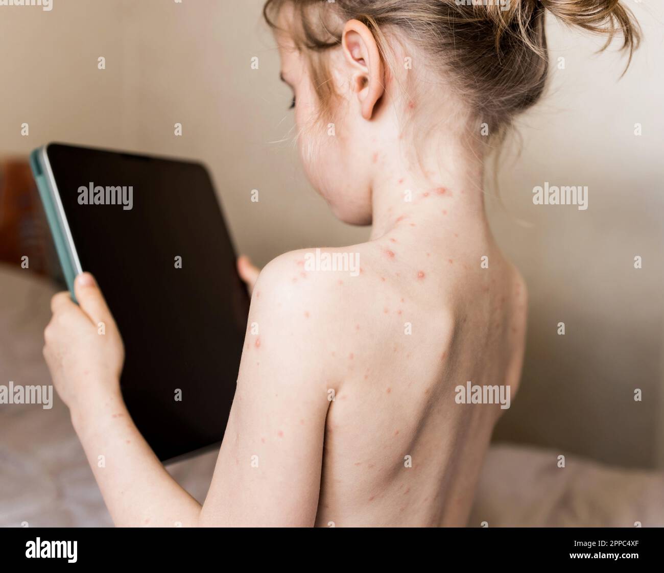 Bambina seduta con la schiena alla fotocamera e guardando il tablet. Varicella, virus della varicella o rash vescicolare sul corpo e sul viso del bambino. Bambino con re Foto Stock