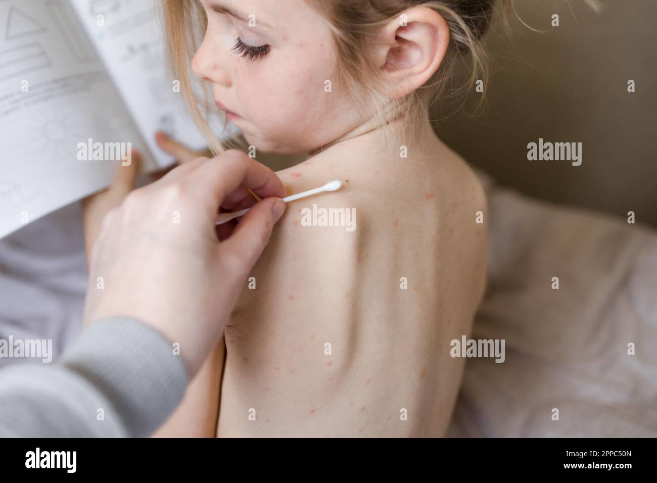Bambina seduta con la schiena alla macchina fotografica e guardando il trattamento delle ulcere da varicella, varicella con crema medica. Capretto con eruzione cutanea rossa sittina Foto Stock