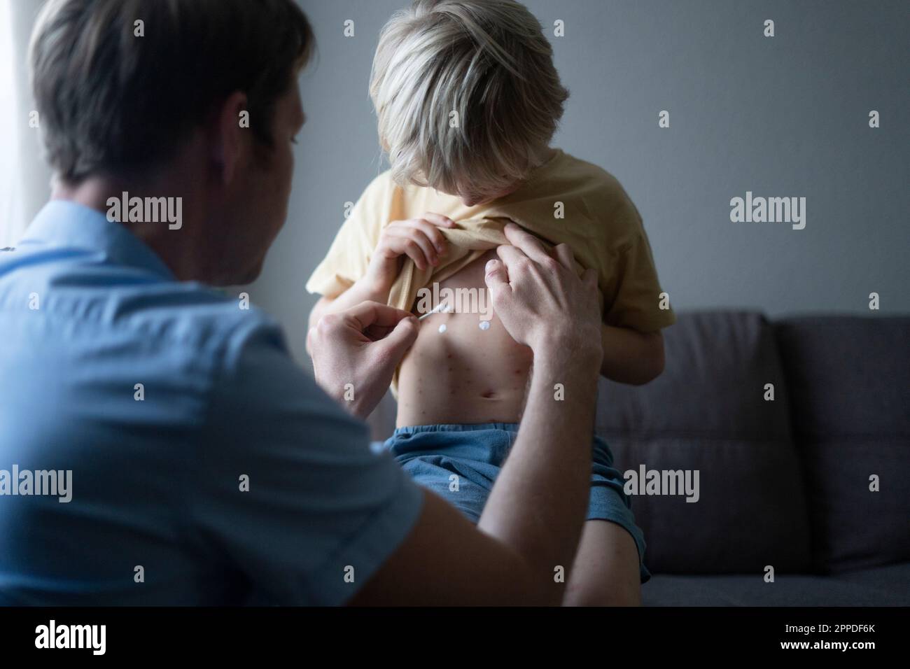 Padre che applica unguento sulla varicella del figlio a casa Foto Stock