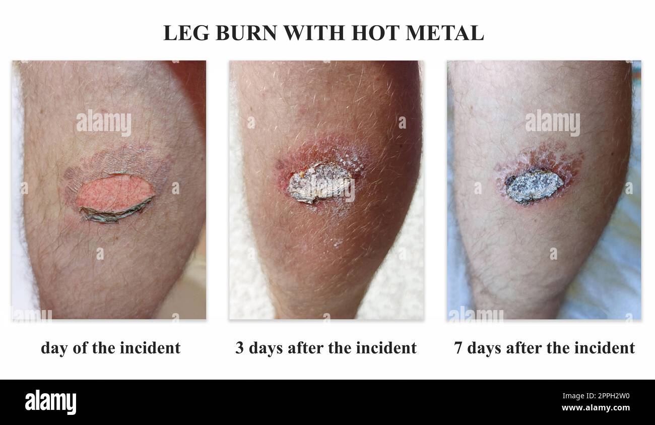 Individuare sulla pelle umana dopo ustione. Vista della gamba umana dopo essere stata bruciata dal metallo caldo Foto Stock