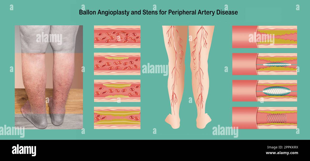 Diagramma che mostra per angioplastica arteria periferica illustrazione della malattia Foto Stock