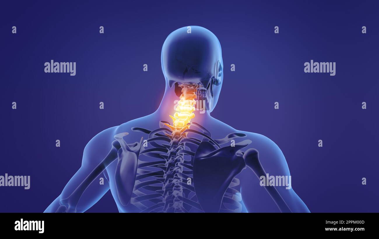 Animazione di un collo doloroso Foto Stock