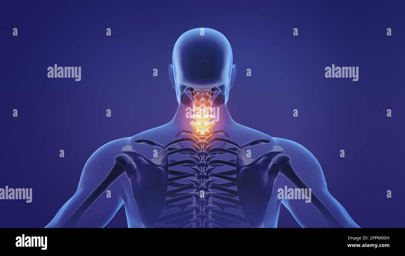Animazione di un collo doloroso Foto Stock