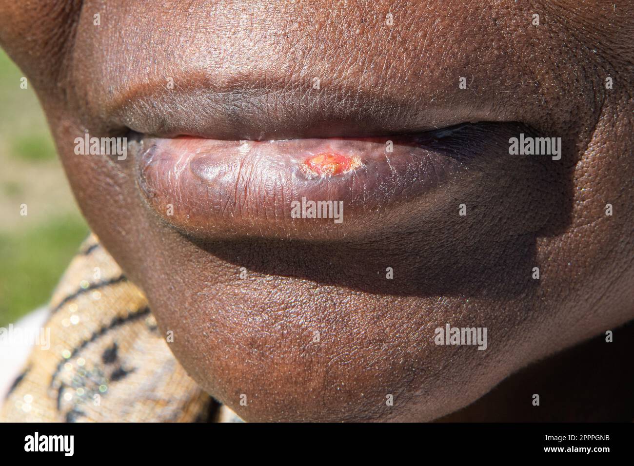 Macro di una ferita fredda in una donna africana. Primo piano delle labbra con Herpes simplex causando pustole gialle e macchie nere. Foto Stock