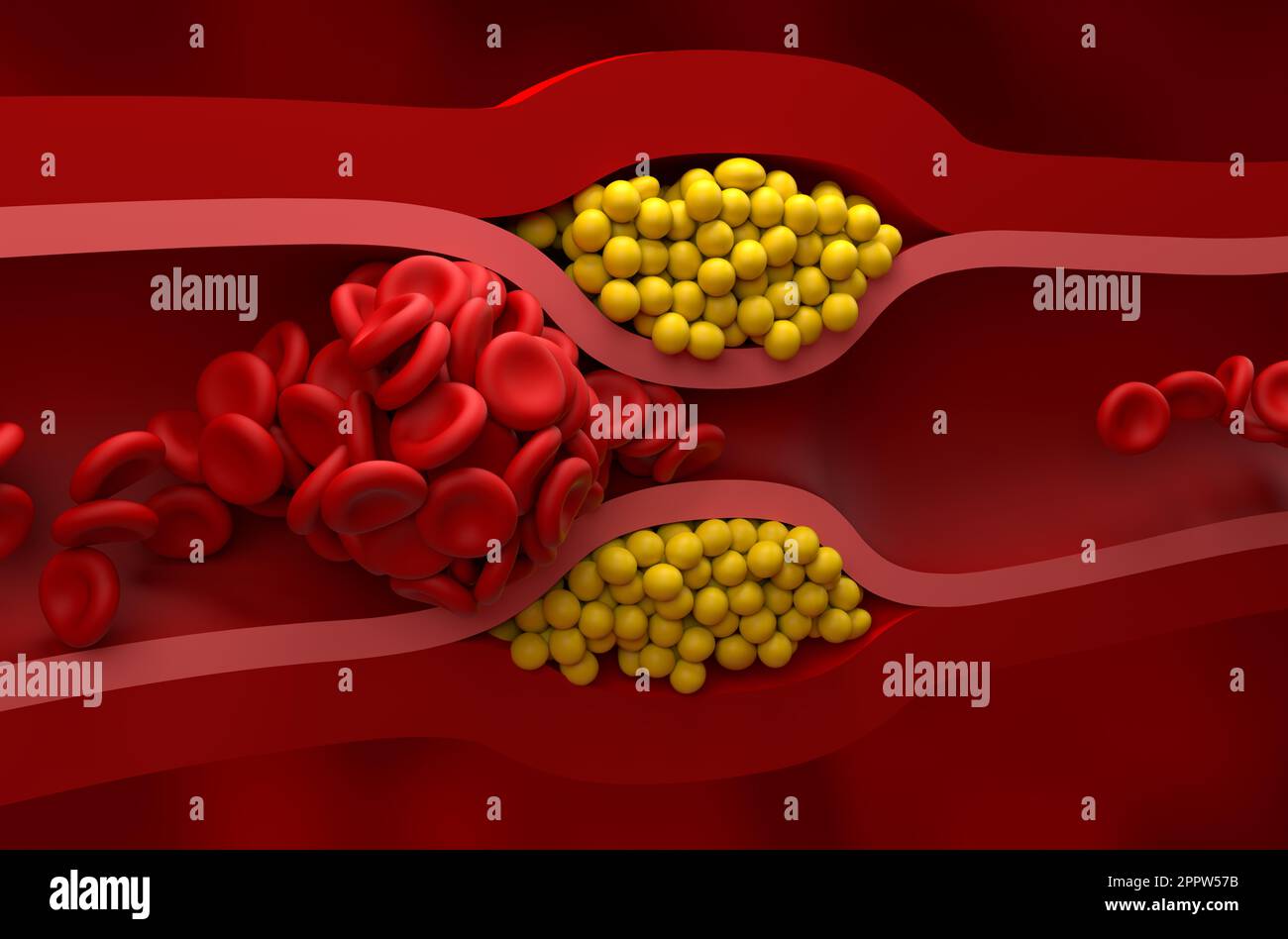 Vaso completamente bloccato in alto livello di LDL (colesterolo cattivo) lipoproteina - Vista closeup 3D illustrazione Foto Stock