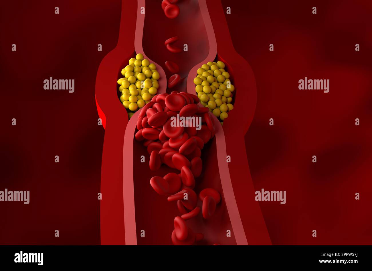Vaso parzialmente bloccato in alto livello di LDL (colesterolo cattivo) lipoproteina - vista frontale 3D illustrazione Foto Stock