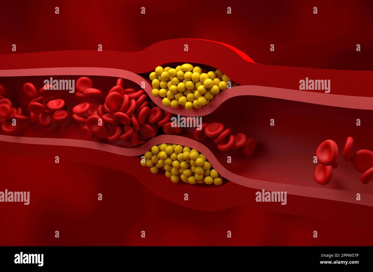Vaso parzialmente bloccato in alto livello di LDL (colesterolo cattivo) lipoproteina - vista isometrica 3D illustrazione Foto Stock
