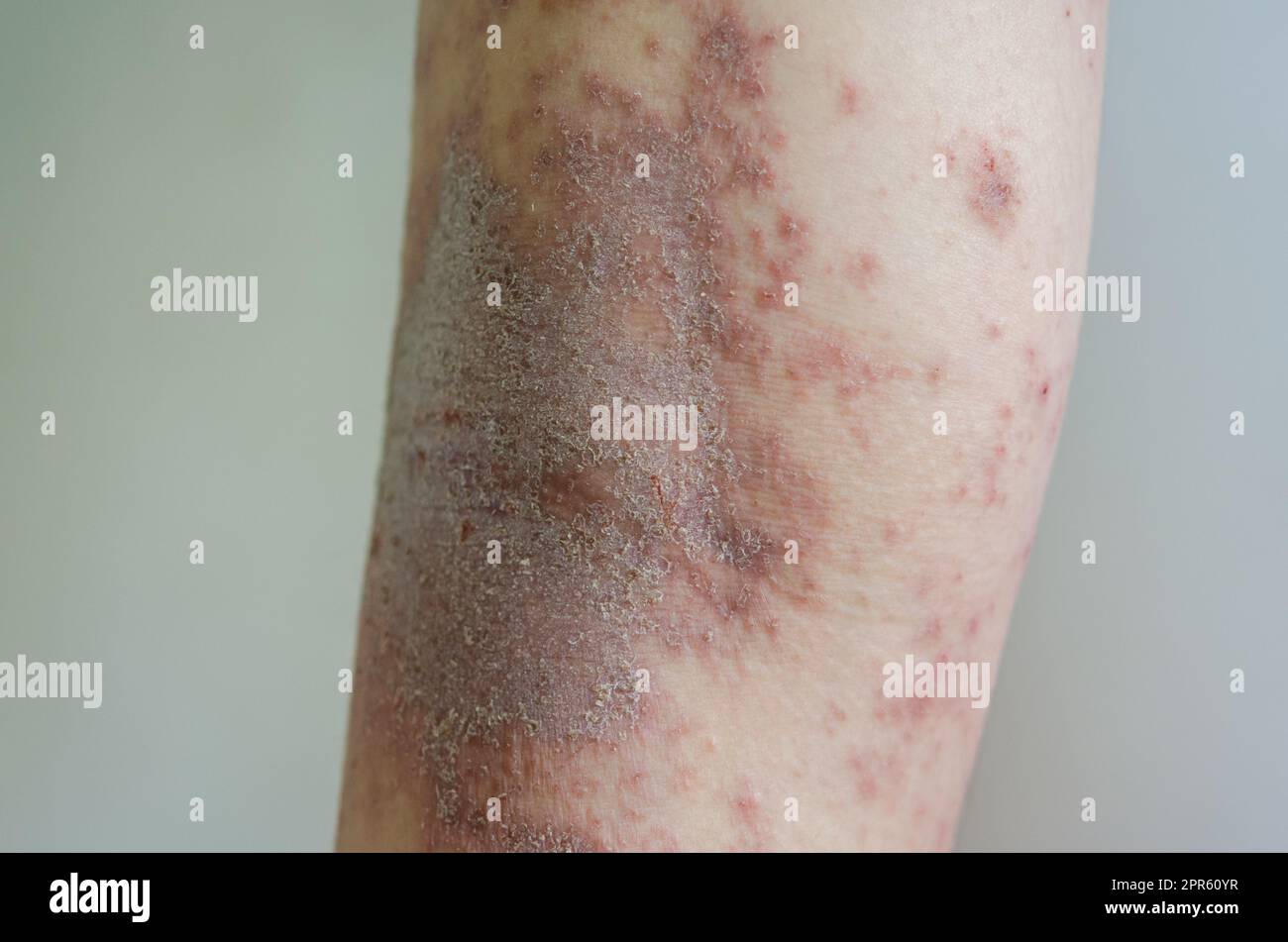 Eruzione cutanea rossa ragazza malattia della pelle causata da allergie a farmaci, cibo, prodotti chimici, sistema immunitario povero nella linfa. Foto Stock