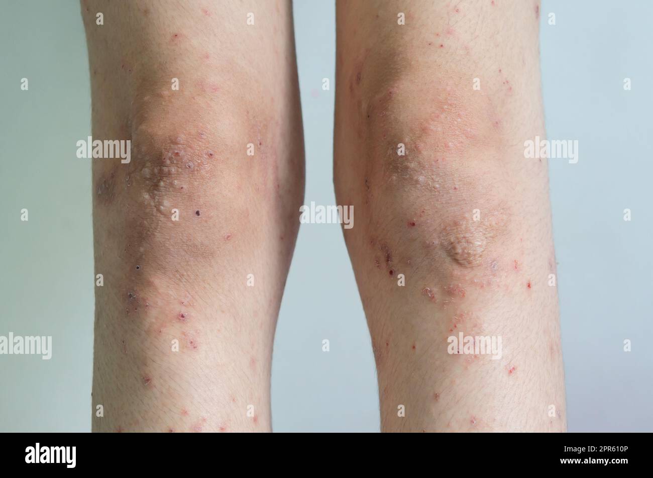 Eruzione cutanea rossa ragazza malattia della pelle causata da allergie a farmaci, cibo, prodotti chimici, sistema immunitario povero nella linfa. Foto Stock