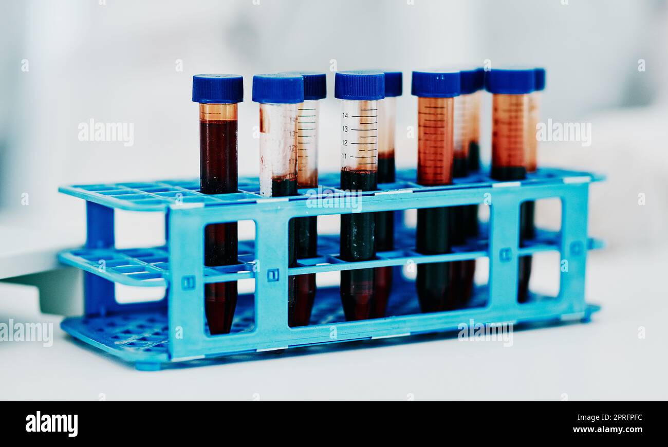 Closeup sangue, provetta o ricerca medica nel laboratorio scientifico per testare, controllare o esaminare il campione di DNA. Alla ricerca di una cura rivoluzionaria per il virus di marburg, il vaiolo monkeyico o la malattia pandemica globale Foto Stock