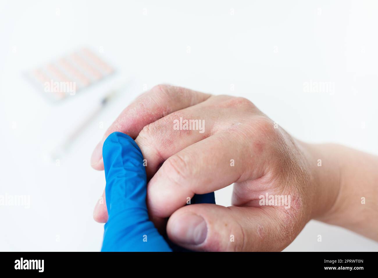 Un uomo mostra un'eruzione arrossata sulle mani al medico. Le cause di prurito cutaneo possono essere dermatite (eczema), pelle secca, ustioni, allergie alimentari. concetto di assistenza sanitaria. Foto Stock