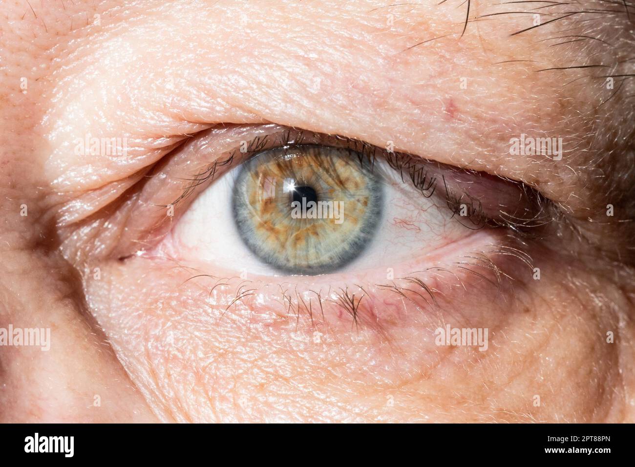 occhio irritato con ispessimento sulla palpebra da primo piano calazio Foto Stock