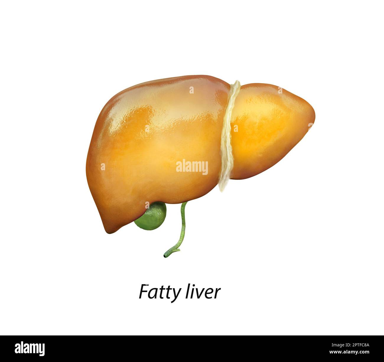 Fegato grasso, steatosi epatica, si verifica in abuso di alcol, sotto l'azione di tossine, fegato danneggiato, fegato grasso, eccessivo consumo di alcol, curatori Foto Stock