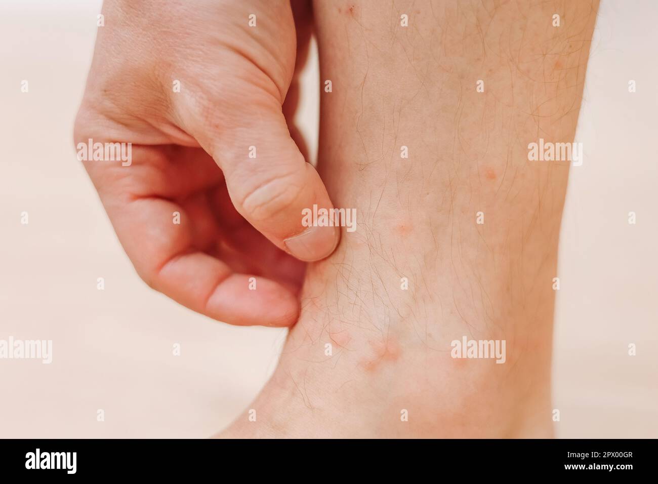 Primo piano l'uomo che graffia con eruzione cutanea allergica alla mano sulla gamba. Gamba con eruzione cutanea rossa causata da punture di insetti. Dermatite, follicolite, infezione fungina. Interessato Foto Stock