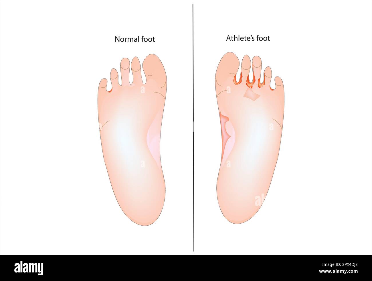 Piede dell'atleta Illustrazione Vettoriale