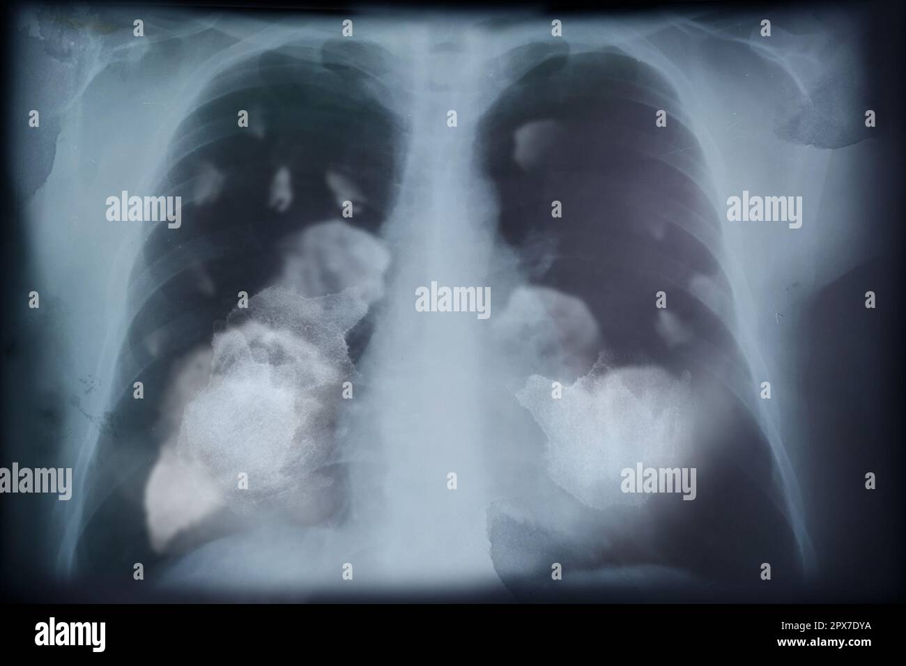 Immagine radiografica di un paziente con cancro polmonare. Illustrazione Foto Stock