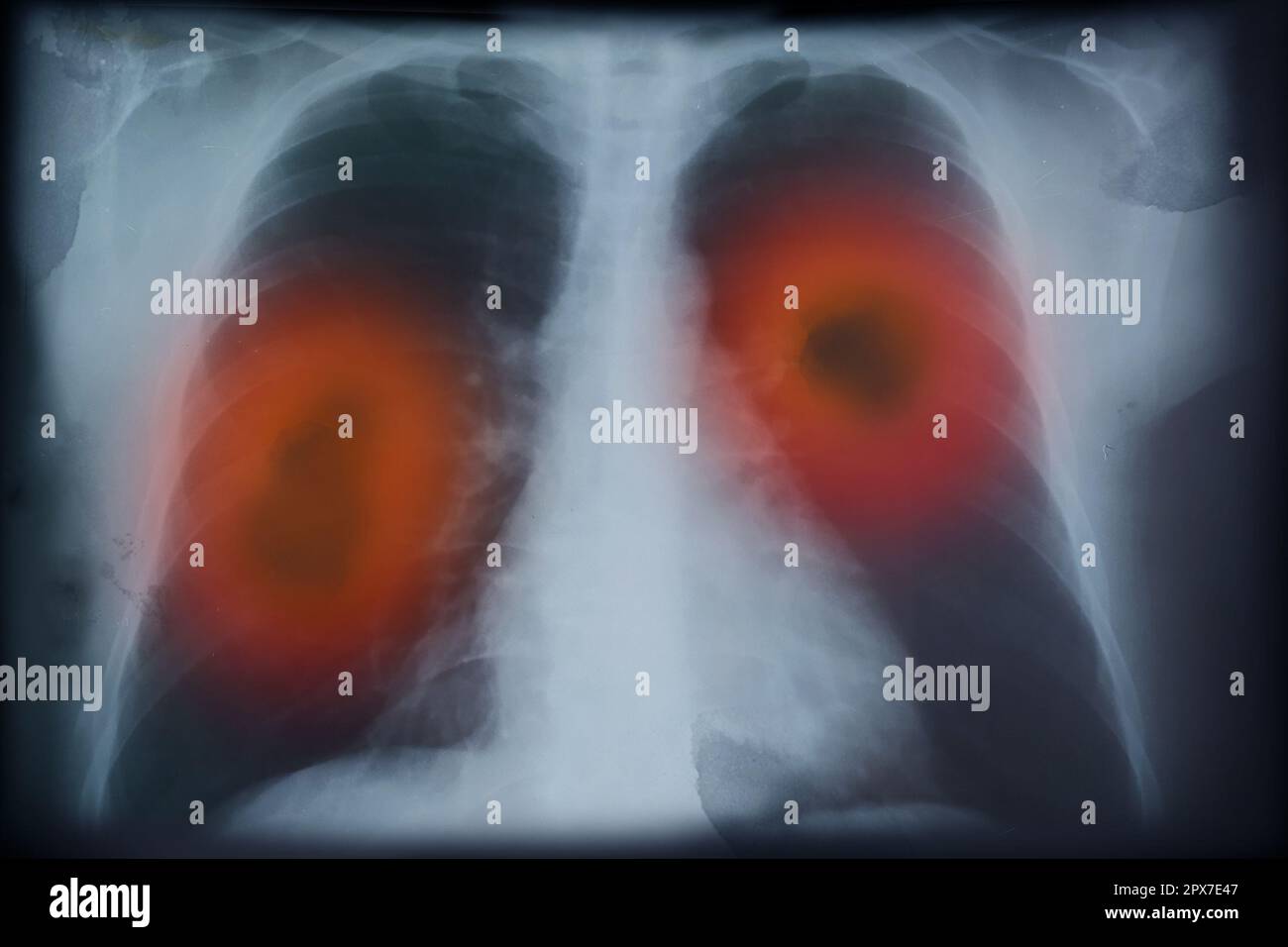 Immagine radiografica di un paziente con cancro polmonare. Illustrazione Foto Stock
