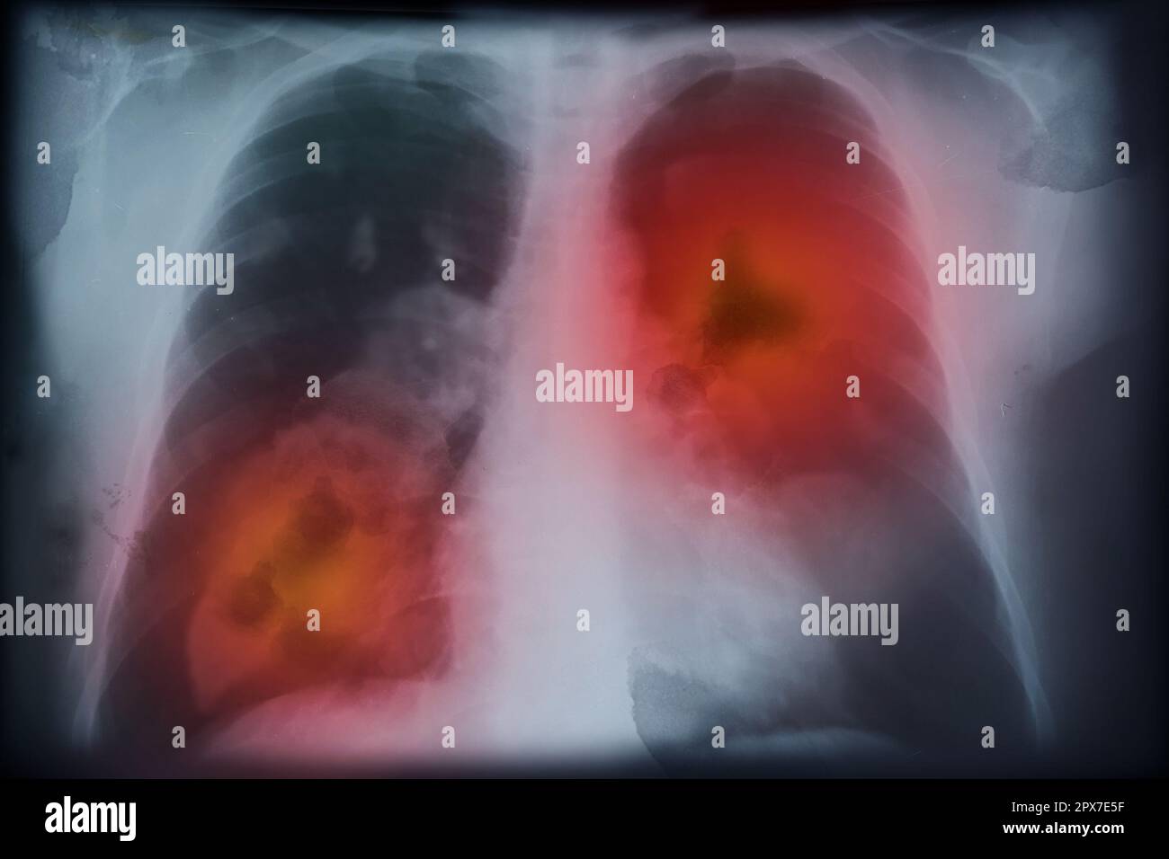 Immagine radiografica di un paziente con cancro polmonare. Illustrazione Foto Stock