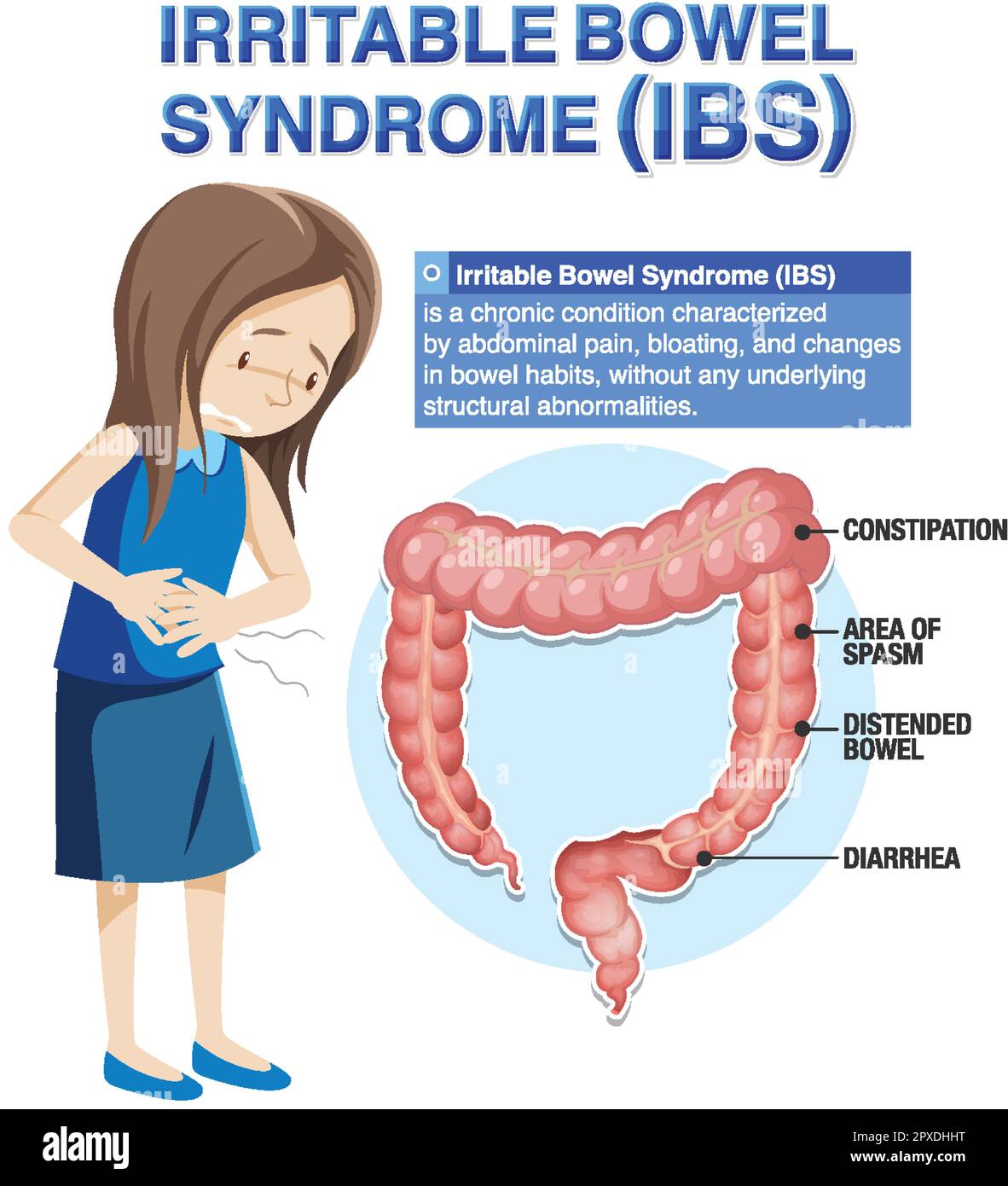 Illustrazione infografica della sindrome dell'intestino irritabile (IBS) Illustrazione Vettoriale