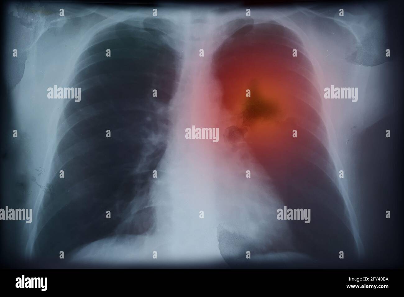 Immagine radiografica di un paziente con cancro polmonare. Illustrazione Foto Stock