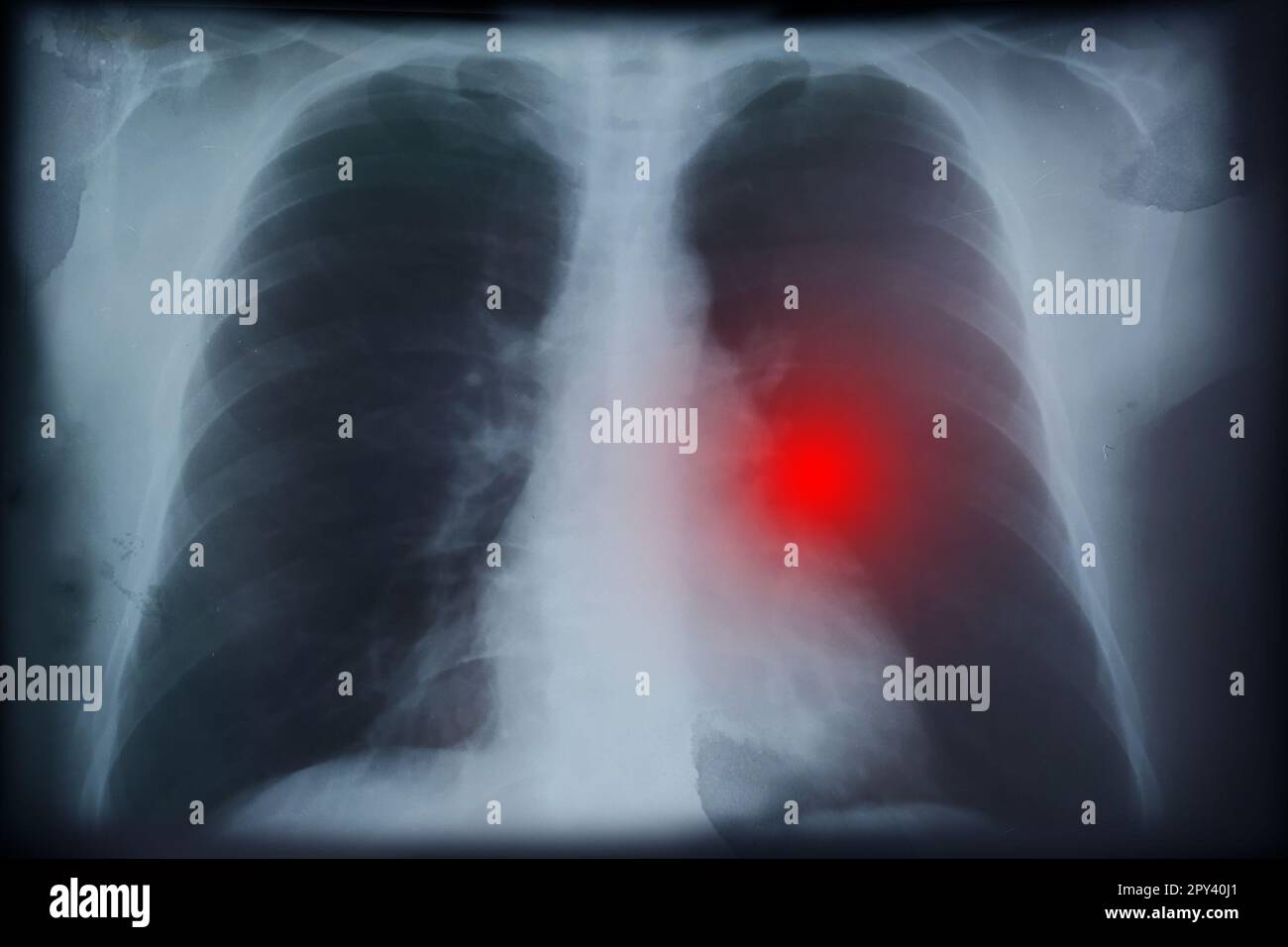 Immagine radiografica di un paziente con cancro polmonare. Illustrazione Foto Stock