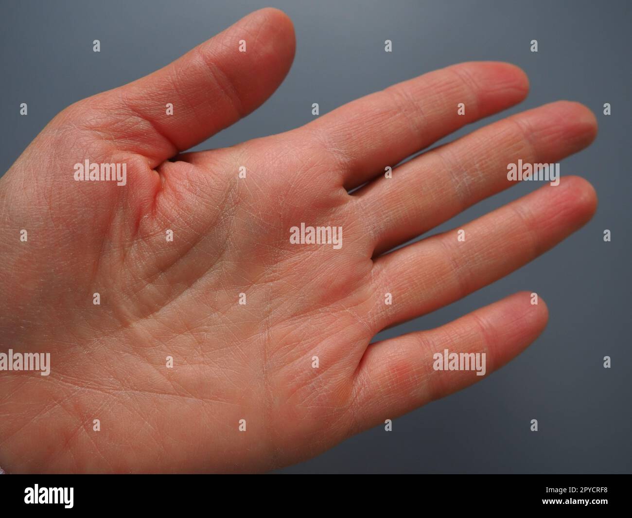 Mano femminile con pelle atopica secca. Sfondo bianco. Primo piano della pelle sul palmo e sulle dita. Problemi dermatologici. Predica la fortuna per le linee sulla mano, palmistry Foto Stock