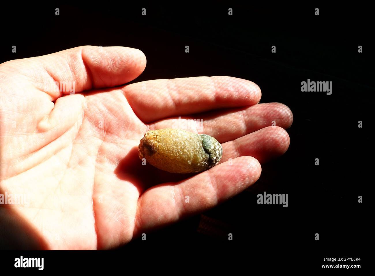 Malattia di calcoli biliari, colelitiasi - la formazione di calcoli, calcoli nella cistifellea, dotti biliari. Calcoli biliari. Un grande calcoli biliari rimosso dal corpo di un paziente, lungo 2,5 cm. Foto Stock