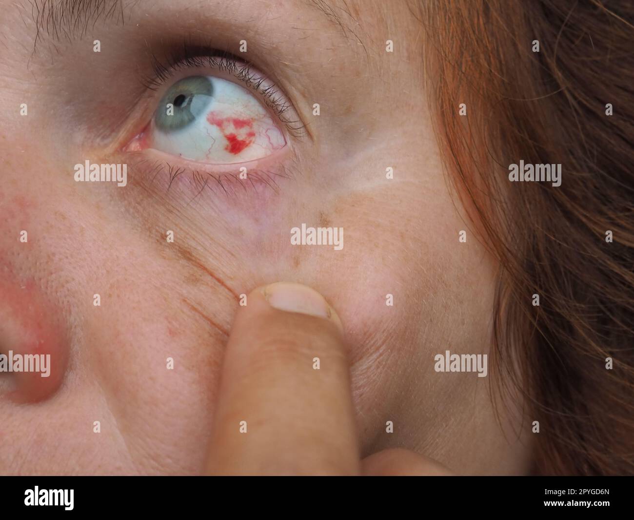 Emorragia subcongiuntivale o emorragia subcongiuntivale, iposhagmus. Sanguinamento sotto la congiuntiva. Vasi sanguigni danneggiati. Il sangue penetra nello spazio tra la congiuntiva e la sclera. Occhi grigi Foto Stock