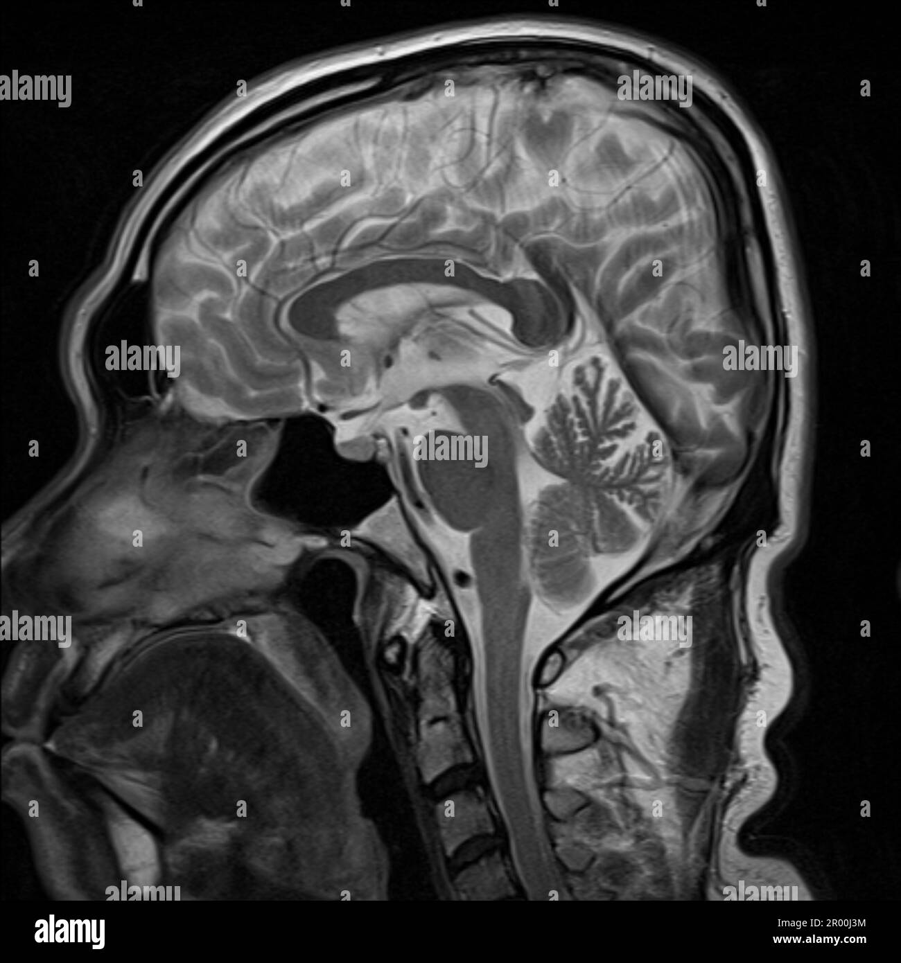 Cervello umano sano, risonanza magnetica Foto Stock
