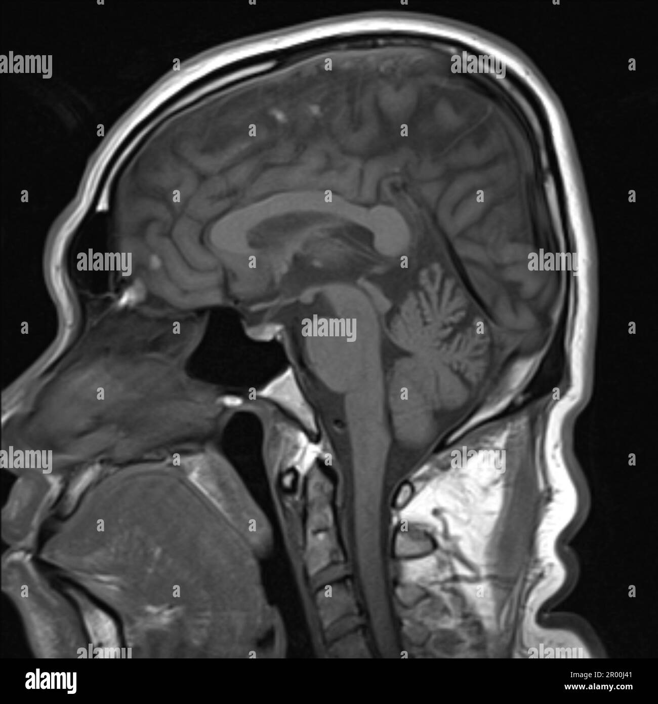 Cervello umano sano, risonanza magnetica Foto Stock