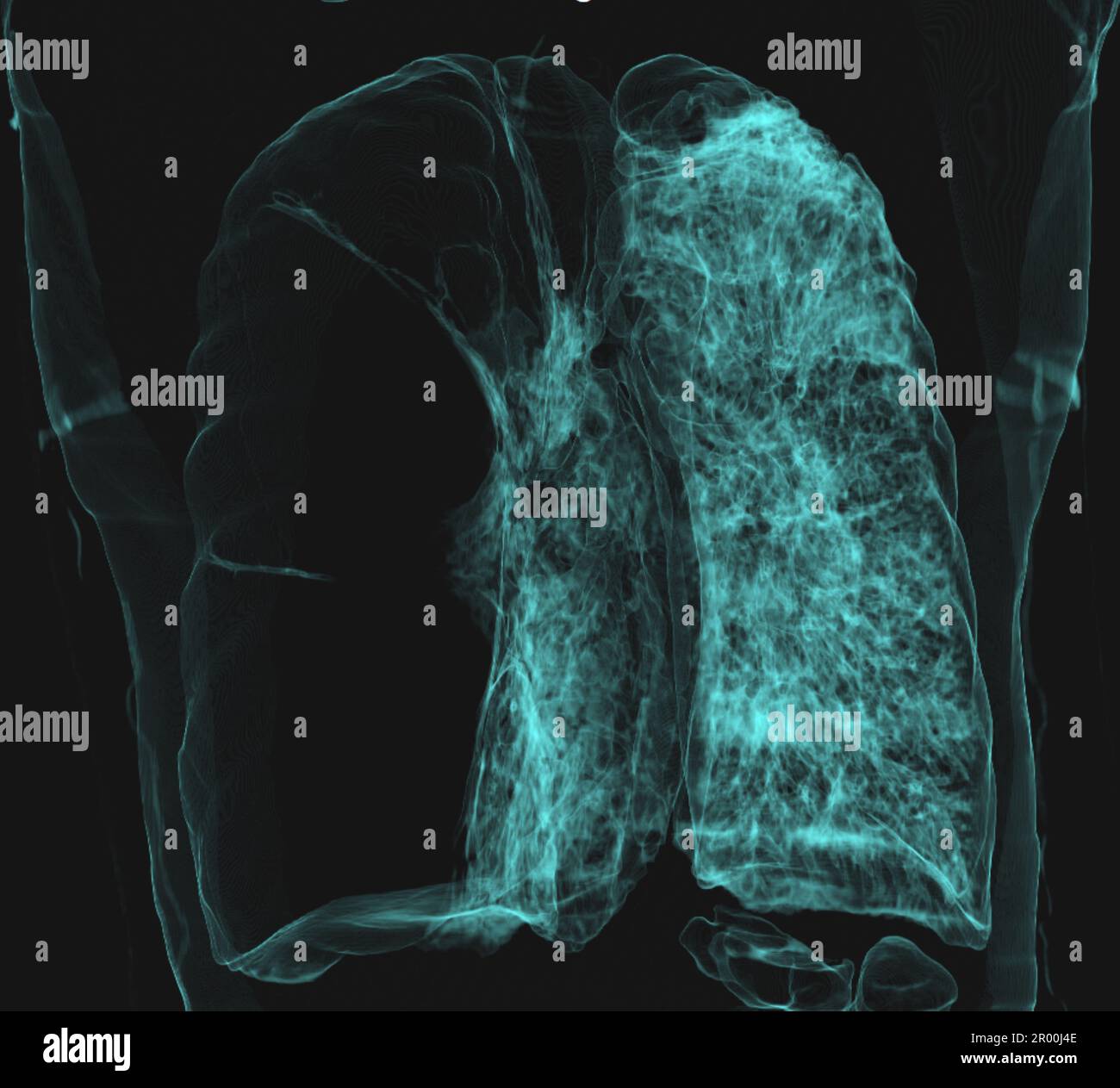 Bulla gigante polmonare, scansione TC Foto Stock
