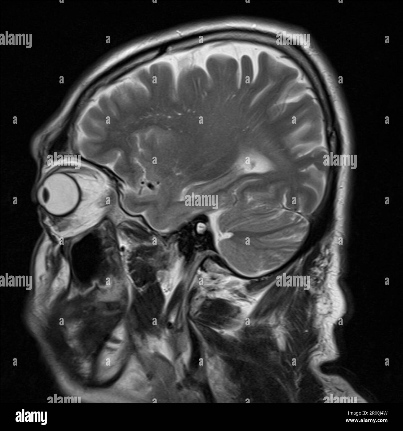 Cervello umano sano, risonanza magnetica Foto Stock