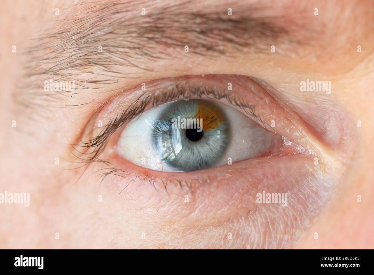 Macro di un occhio umano con eterocromia. Estremo primo piano dell'occhio umano di due diversi colori: Blu e marrone Foto Stock