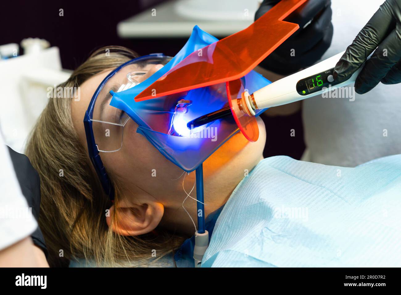 Ripristino della superficie di masticazione con materiale di riempimento in fotopolimero. Dentista che lavora con la lampada UV di polimerizzazione dentale in cavità orale Foto Stock