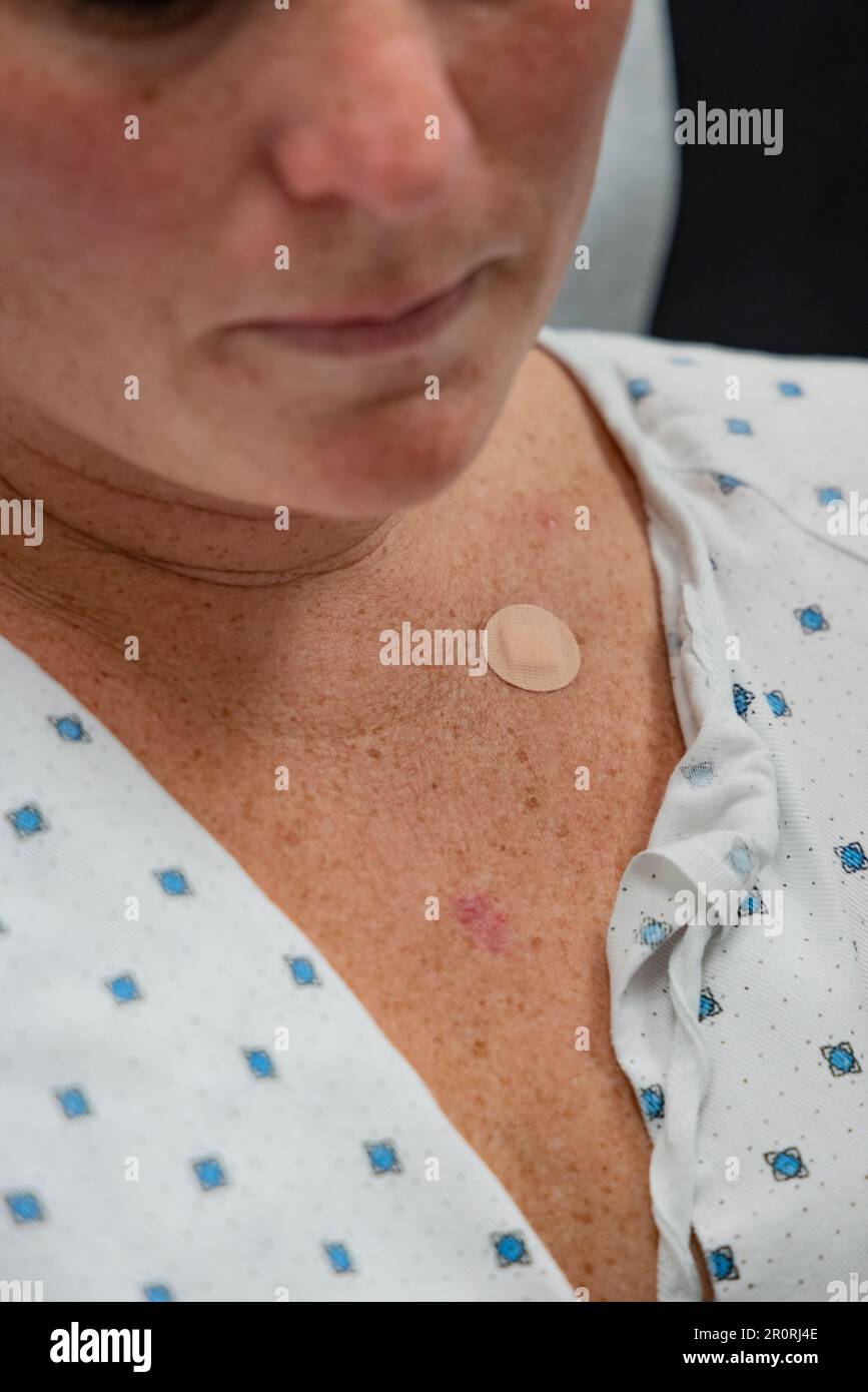 Primo piano della donna all'appuntamento dermatologico per la procedura di carcinoma basocellulare della pelle. Foto Stock