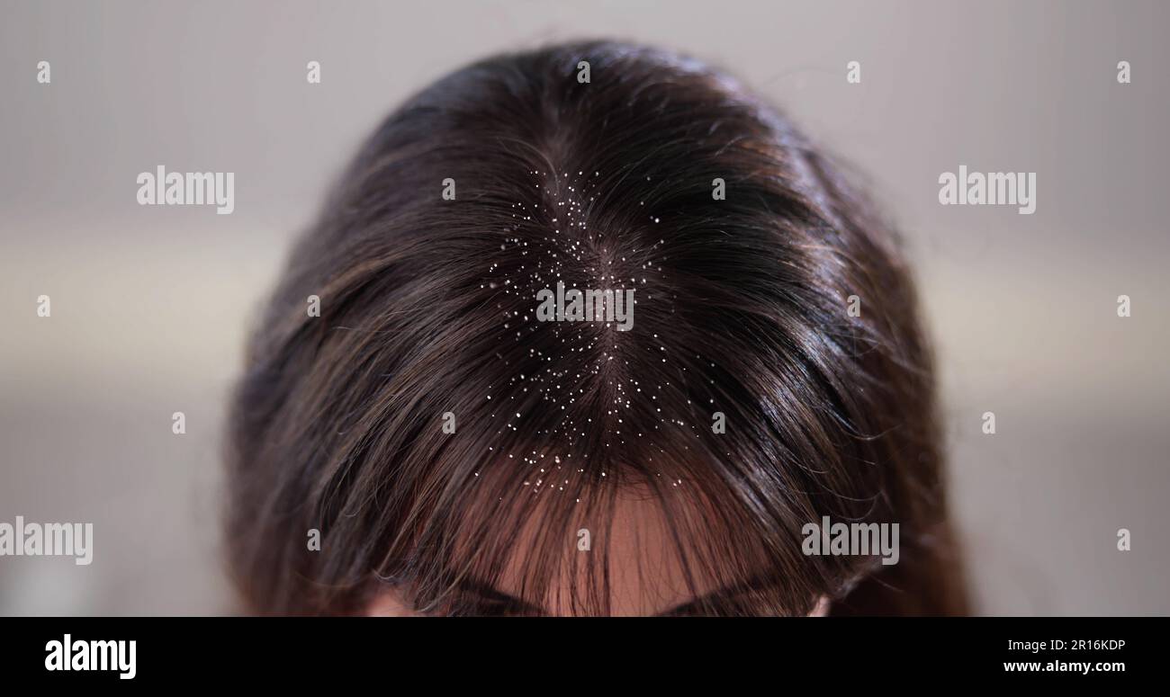 Prurito testa cuoio capelluto e capelli Dandruff problema Foto Stock