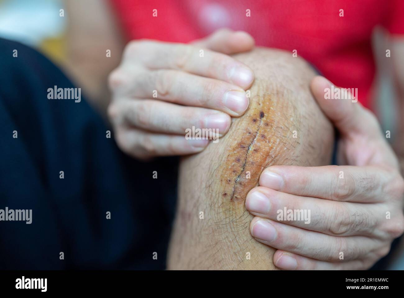 rilasciare manualmente una cicatrice fresca, esercitando una leggera pressione con le dita dai lati Foto Stock