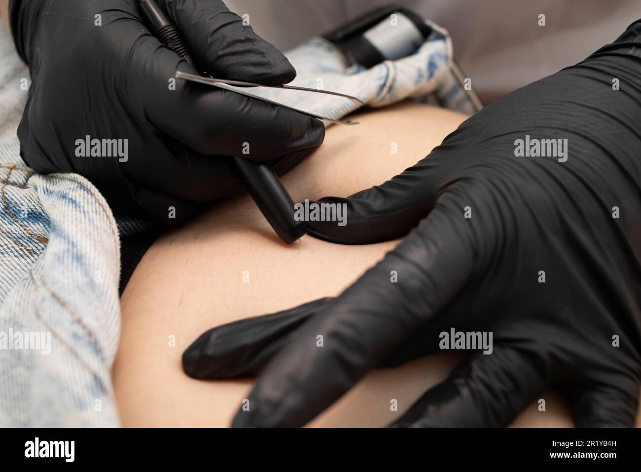 Dermatologo corto rimuove i capelli sul ventre della donna, Addome con procedura di elettrolisi, epilazione elettrica nel salone di bellezza. Piano orizzontale Foto Stock