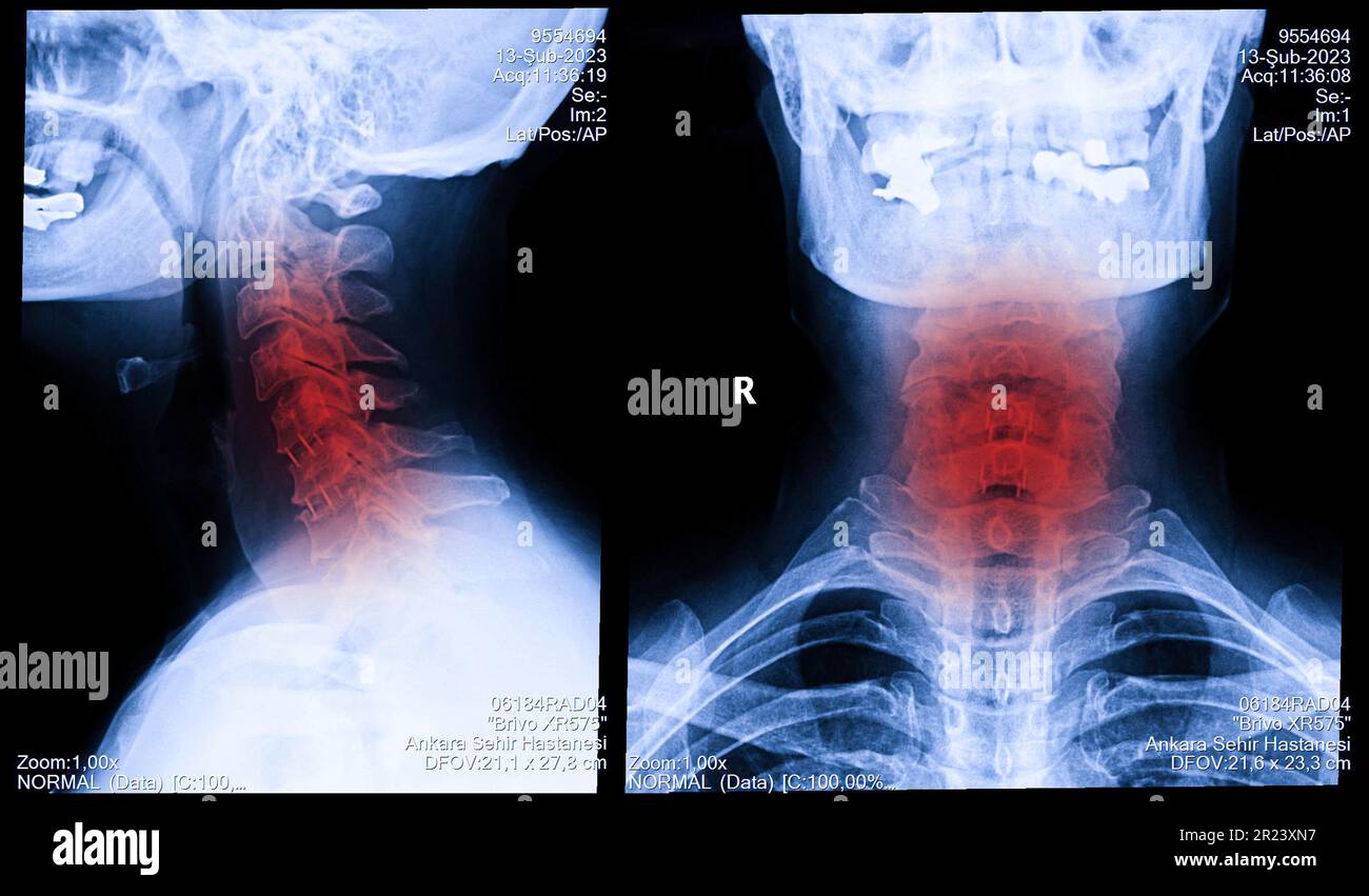 Vista radiografica del collo e della colonna cervicale. Immagine della radiografia di pazienti con dolore al collo, compressione della radice nervosa, intorpidimento al polso o all'aletta della mano del braccio Foto Stock